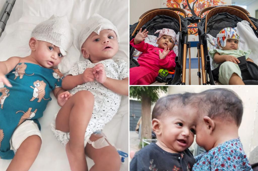 Conjoined twins born with conjoined brain tissue were separated after a risky operation